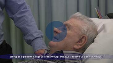 Embedded thumbnail for Επιτυχής αφαίρεση κήλης με δισκεκτομή (MISS), σε ασθενή με χρόνιες παθήσεις