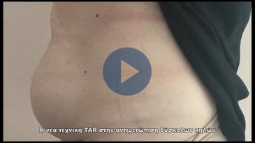 Embedded thumbnail for Η σύγχρονη τεχνική TAR για την αντιμετώπιση μεγάλων &amp;amp; δύσκολων κοιλιοκηλών