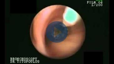 Embedded thumbnail for Ενδοπροσθέσεις τραχείας - Βρόγχων (STENTS)