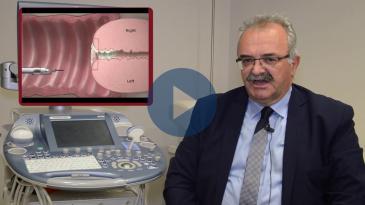 Embedded thumbnail for Η θεραπεία των κονδυλωμάτων με laser