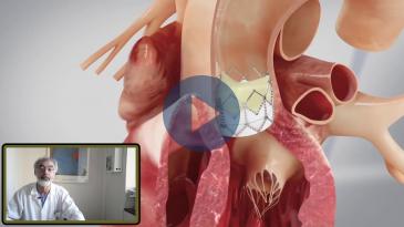 Embedded thumbnail for Η διαδερμική εμφύτευση αορτικής βαλβίδας (TAVI), στο Διαβαλκανικό