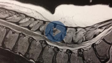 Embedded thumbnail for Ολικές αρθροπλαστικές σε εφήβους με σπονδυλοεπιφυσιακή δυσπλασία