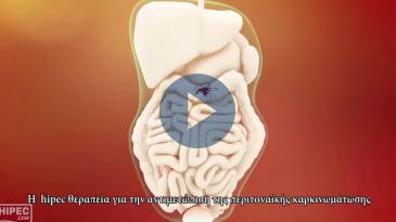 Embedded thumbnail for Η μέθοδος hipec για την αντιμετώπιση της περιτοναϊκής καρκινωμάτωσης