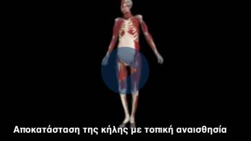Embedded thumbnail for Αποκατάσταση της κήλης με τοπική αναισθησία