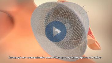 Embedded thumbnail for Αποφυγή εγκεφαλικών επεισοδίων με σύγκληση του αριστερού ωτίου της καρδιάς