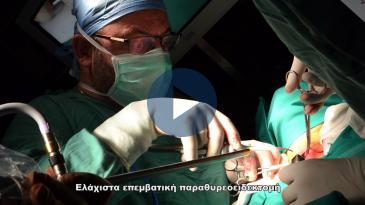 Embedded thumbnail for Ελάχιστα επεμβατική παραθυρεοειδεκτομή