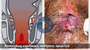 Embedded thumbnail for Καλοήθεις επώδυνες παθήσεις πρωκτού