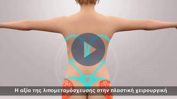 Embedded thumbnail for Η αξία της λιπομεταμόσχευσης στην πλαστική χειρουργική