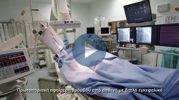 Embedded thumbnail for Πρωτοποριακή αφαίρεση θρόμβου από ασθενή, με διπλό εγκεφαλικό