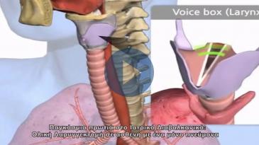 Embedded thumbnail for Η πρώτη επέμβαση ολικής λαρυγγεκτομής παγκοσμίως σε ασθενή με ένα πνεύμονα