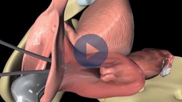 Embedded thumbnail for «Στο Διαβαλκανικό συντελέσθηκε ένα θαύμα…» - Μητέρα νεαρής με 52 ινομυώματα