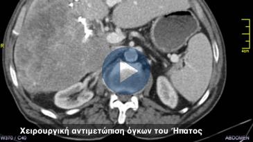 Embedded thumbnail for Χειρουργική αντιμετώπιση όγκων του Ήπατος
