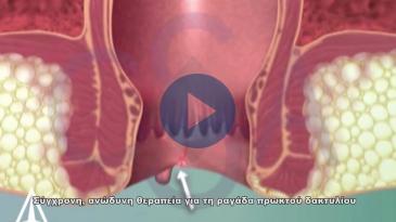 Embedded thumbnail for Ανώδυνη, μη επεμβατική θεραπεία για τη ραγάδα πρωκτού
