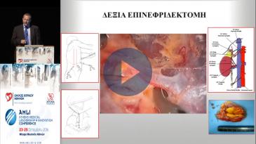 Embedded thumbnail for Παναγιώτης Κέκης - Λαπαροσκοπική επινεφριδεκτομή - Νεότερα δεδομένα