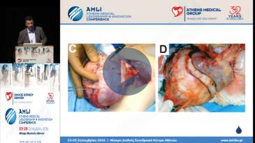 Embedded thumbnail for Γεώργιος Σπυρίδης - Εξελίξεις στη χειρουργική συμπαγών όγκων κοιλίας στα παιδιά