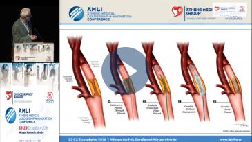 Embedded thumbnail for Αλέξανδρος Γουγουλάκης - Ενδαγγειακή θεραπεία καρωτιδικής νόσου - State of the Art