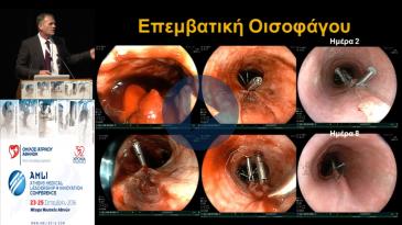 Embedded thumbnail for Δημήτριος Καραγιάννης - Επεμβατική γαστρεντερολογία. Παρελθόν, παρόν και μέλλον