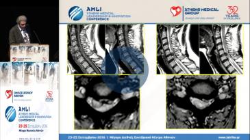 Embedded thumbnail for Καραγιαννίδης-Χειρουργική αντιμετώπιση παθήσεων αυχενικής μοίρας σπονδυλικής στήλης.Λύσεις με Ο-arm