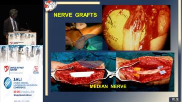 Embedded thumbnail for Π. Γιαννακόπουλος-Μικροχειρουργική: μία σύγχρονη τεχνική για την αντιμετώπιση παθήσεων των άκρων