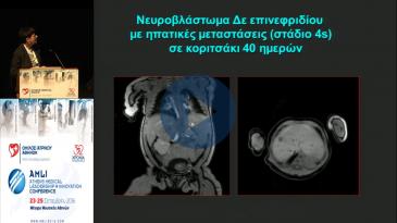 Embedded thumbnail for Αν.Στασινοπούλου-Προκλήσεις στην παιδιατρική ογκολογία:παράδειγμα όγκων κοιλίας και μαλακών μορίων