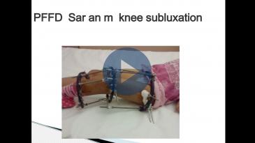 Embedded thumbnail for Λαλιώτης-Η αναγέννηση των δυσπλασικών άκρων στα παιδιά,με τη διατατική ιστογένεση(μέθοδος Ilizarov)