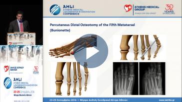 Embedded thumbnail for Αναστάσιος Αποστολόπουλος - Βλαισός μέγας δάκτυλος. Η εμπειρία μας