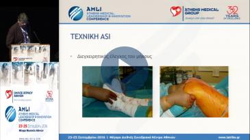 Embedded thumbnail for Iωάννης Τσαρούχας - Oλική αρθροπλαστική ισχίου με τη μέθοδο ASI