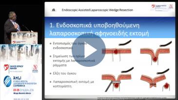 Embedded thumbnail for Κ. Γέμος - Υβριδικές λαπαροσκοπικές και ενδοσκοπικές τεχνικές για την εξαίρεση GIST στομάχου