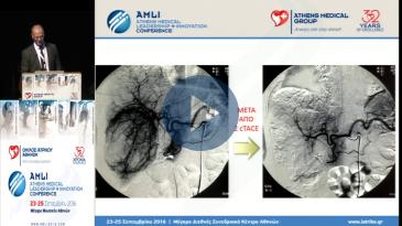 Embedded thumbnail for Δέδες-Xημειοεμβολισμός:γέφυρα σε θεραπευτικές μεθόδους σε ανεγχείρητο μονήρη ηπατοκυτταρικό καρκίνο