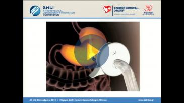 Embedded thumbnail for Φωτεινή Λαούδη - AspireAssist: απώλεια βάρους χωρίς χειρουργική επέμβαση