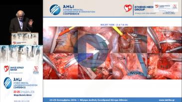 Embedded thumbnail for Δ.Φιλίππου - Minimally invasive thoracic surgery-Εμπειρία Ιατρικό Διαβαλκανικό Θεσσαλονίκης