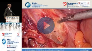 Embedded thumbnail for Ιωάννης Μπολάνης - Διασφιγκτηριακή εκτομή με αποφυγή κολοστομίας στον πολύ χαμηλό καρκίνο του ορθού