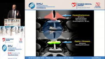 Embedded thumbnail for Νικόλαος Φόρογλου - Η χειρουργική της υπόφυσης - Παρόν και μέλλον