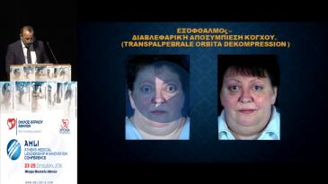 Embedded thumbnail for Γεώργιος Ανδρεανίδης - Χειρουργική αντιμετώπιση του εξωφθάλμου - Διαβλεφαρική αποσυμπίεση