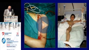 Embedded thumbnail for Αλέξανδρος Μπερής - Μικροχειρουργική εφαρμογή της αγγειούμενης περόνης σε οστικά προβλήματα