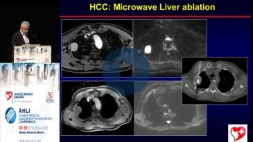 Embedded thumbnail for Αντώνης Δρεβελέγκας - Ablation στην ογκολογία